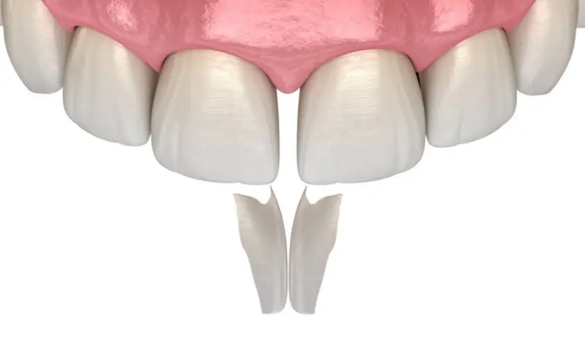 Family Dentistry of Forest Hill | Why Dental Bonding Might Be What You Need – Ask Your Dental Specialist