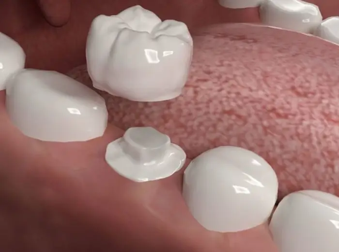 Family Dentistry of Forest Hill | Porcelain Crowns
