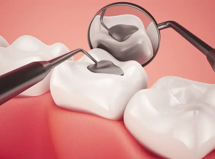 Family Dentistry of Forest Hill | Composite Fillings