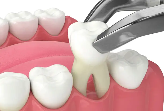 Family Dentistry of Forest Hill | Tooth Extraction