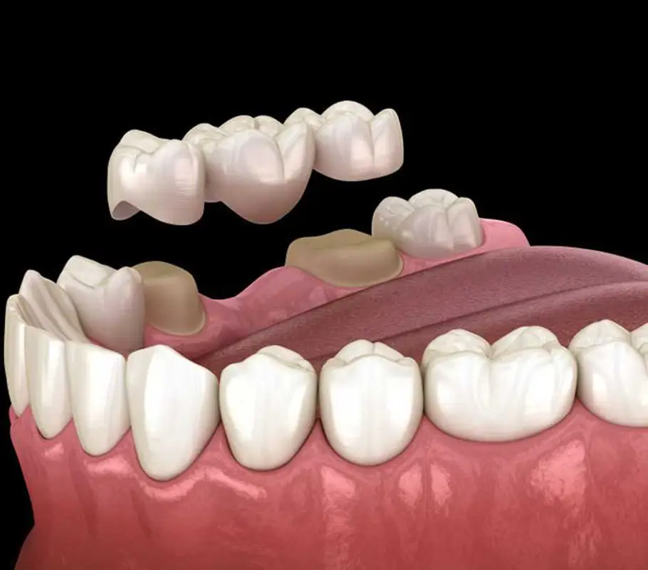 Family Dentistry of Forest Hill | Dental Bridges