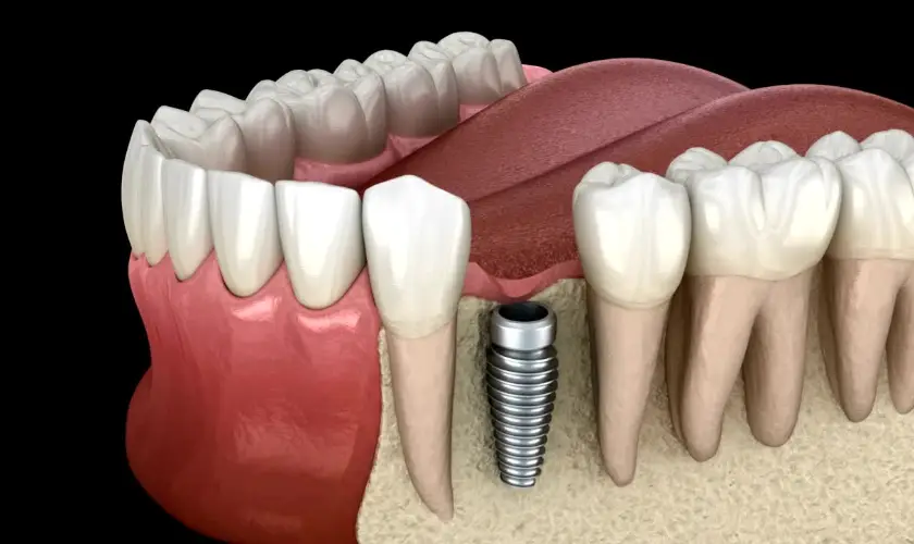 Family Dentistry of Forest Hill | How Dental Implants Can Improve Your Quality of Life