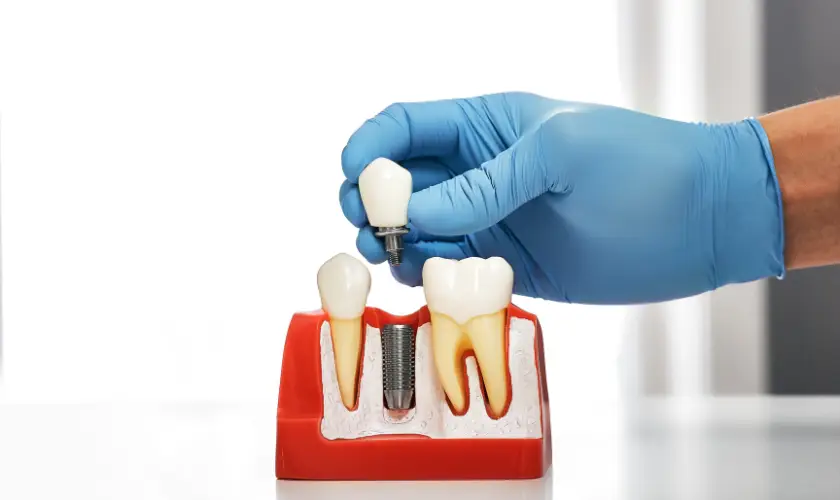 Family Dentistry of Forest Hill | Dental Implants: Crafting a Natural-Looking Smile