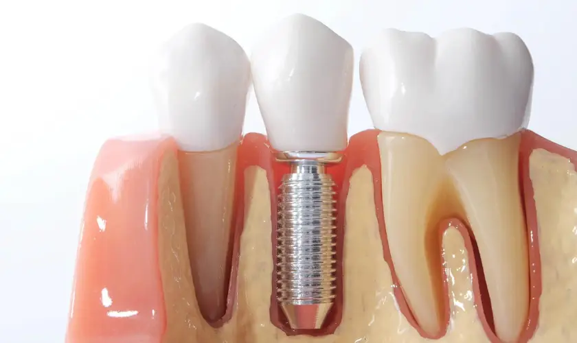 Family Dentistry of Forest Hill | Understanding the Benefits of Dental Implants