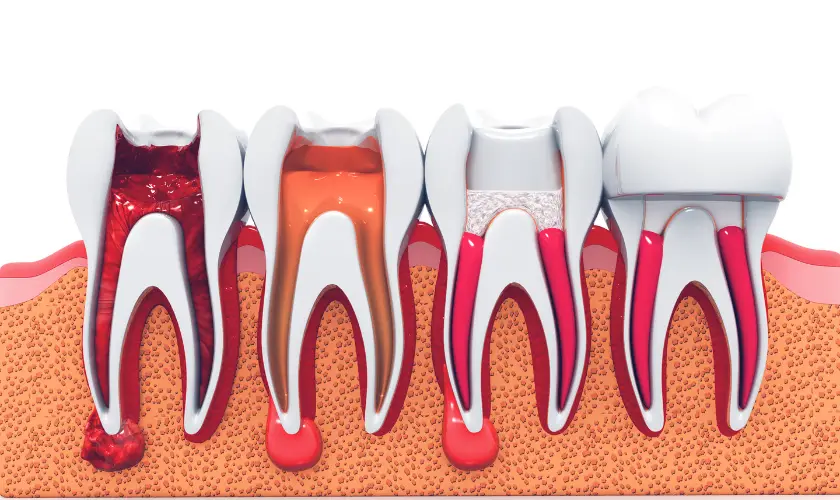 Family Dentistry of Forest Hill | Understanding Root Canal Therapy in Children