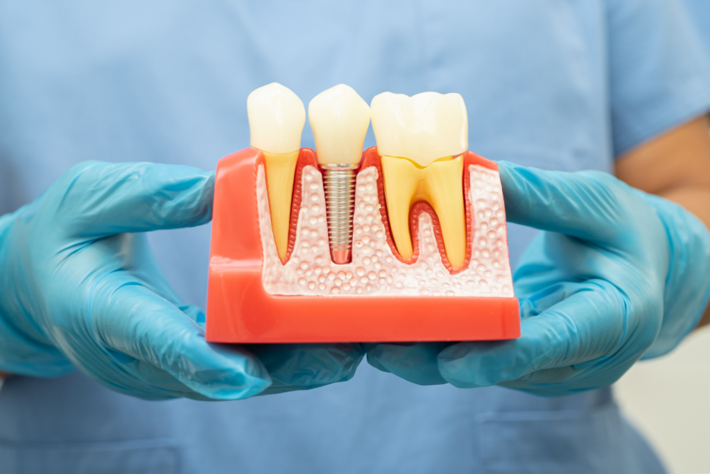 Family Dentistry of Forest Hill | How Many Days Should You Rest After Getting A Dental Implant? Family Dentistry of Forest Hill | How Many Days Should You Rest After Getting A Dental Implant?