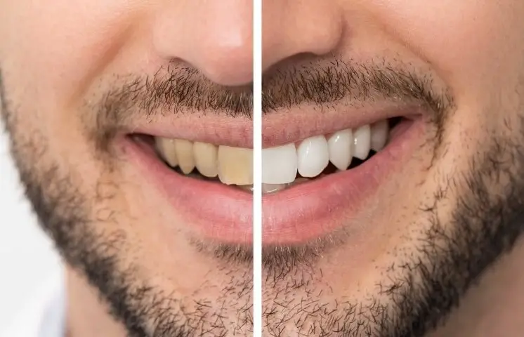 Family Dentistry of Forest Hill | Teeth Whitening Trends for 2024: What's Hot This Christmas?