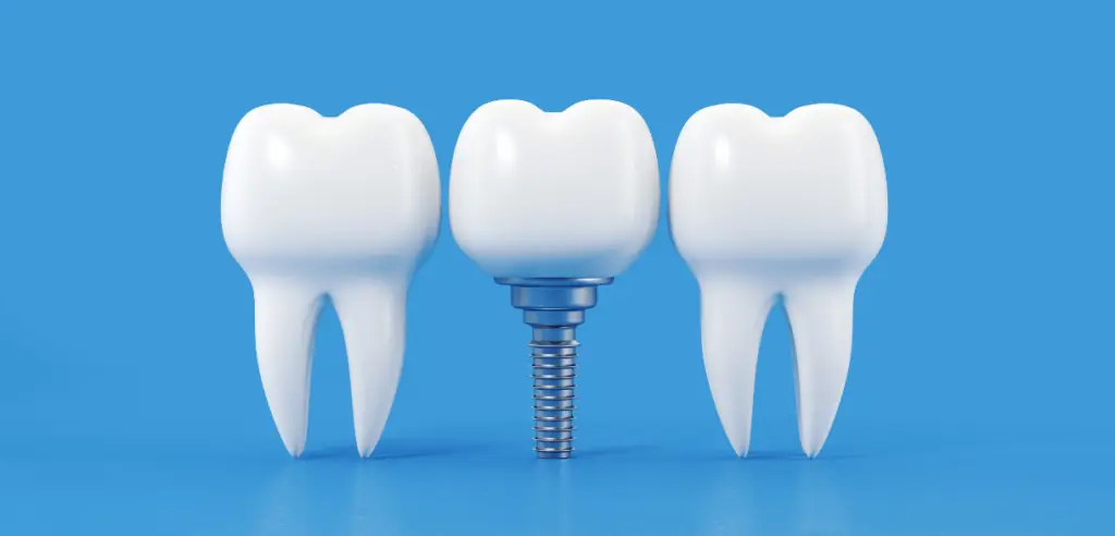 Family Dentistry of Forest Hill | Can You Get Dental Implants If You Have Gum Disease Family Dentistry of Forest Hill | Can You Get Dental Implants If You Have Gum Disease
