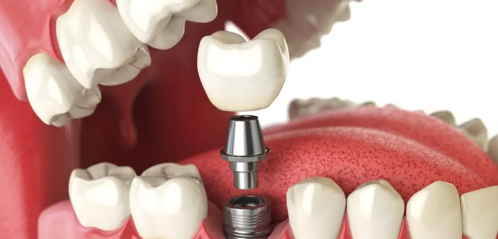 Family Dentistry of Forest Hill | Are Dental Implants The Best Tooth Replacement Option?