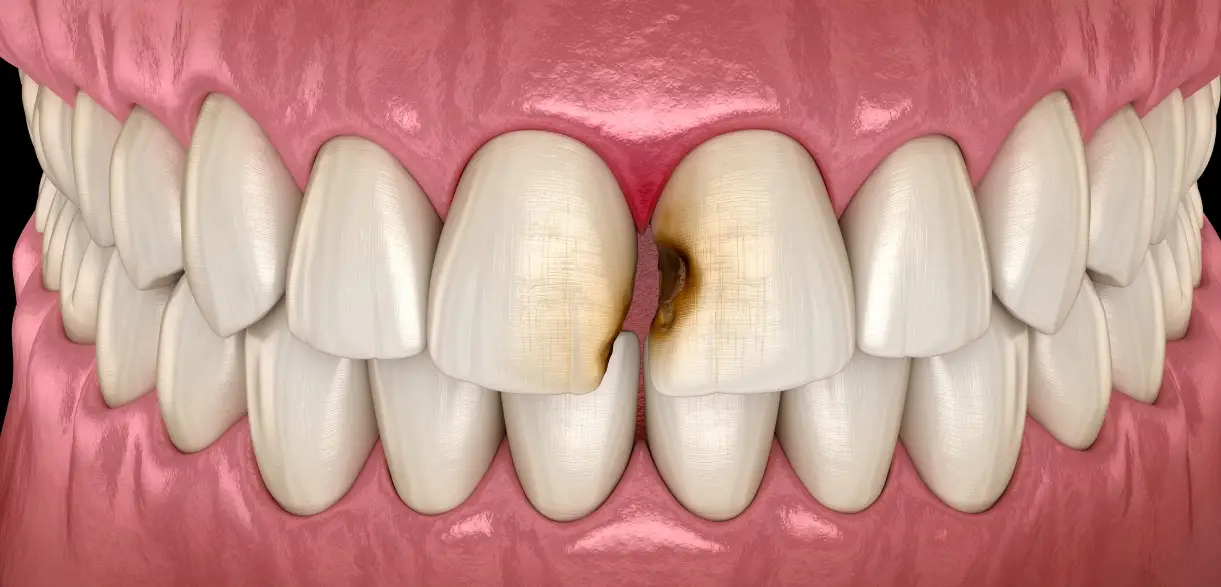Family Dentistry of Forest Hill |  Tooth Abscess Emergency: Symptoms, Risks & When to Seek Help