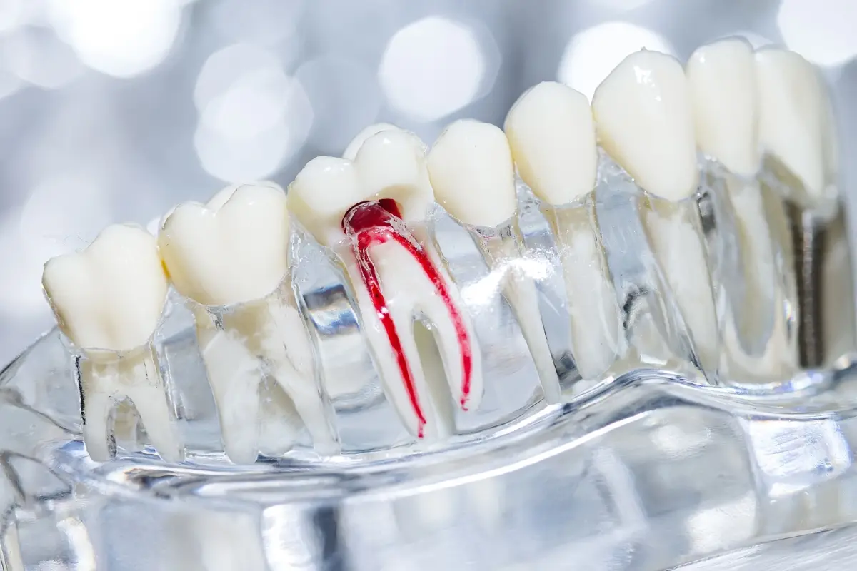 Family Dentistry of Forest Hill | How to Prepare for a Root Canal in West Palm Beach?
