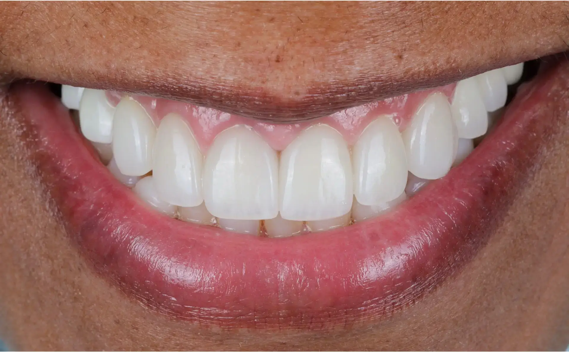 Family Dentistry of Forest Hill | Smile Gallery