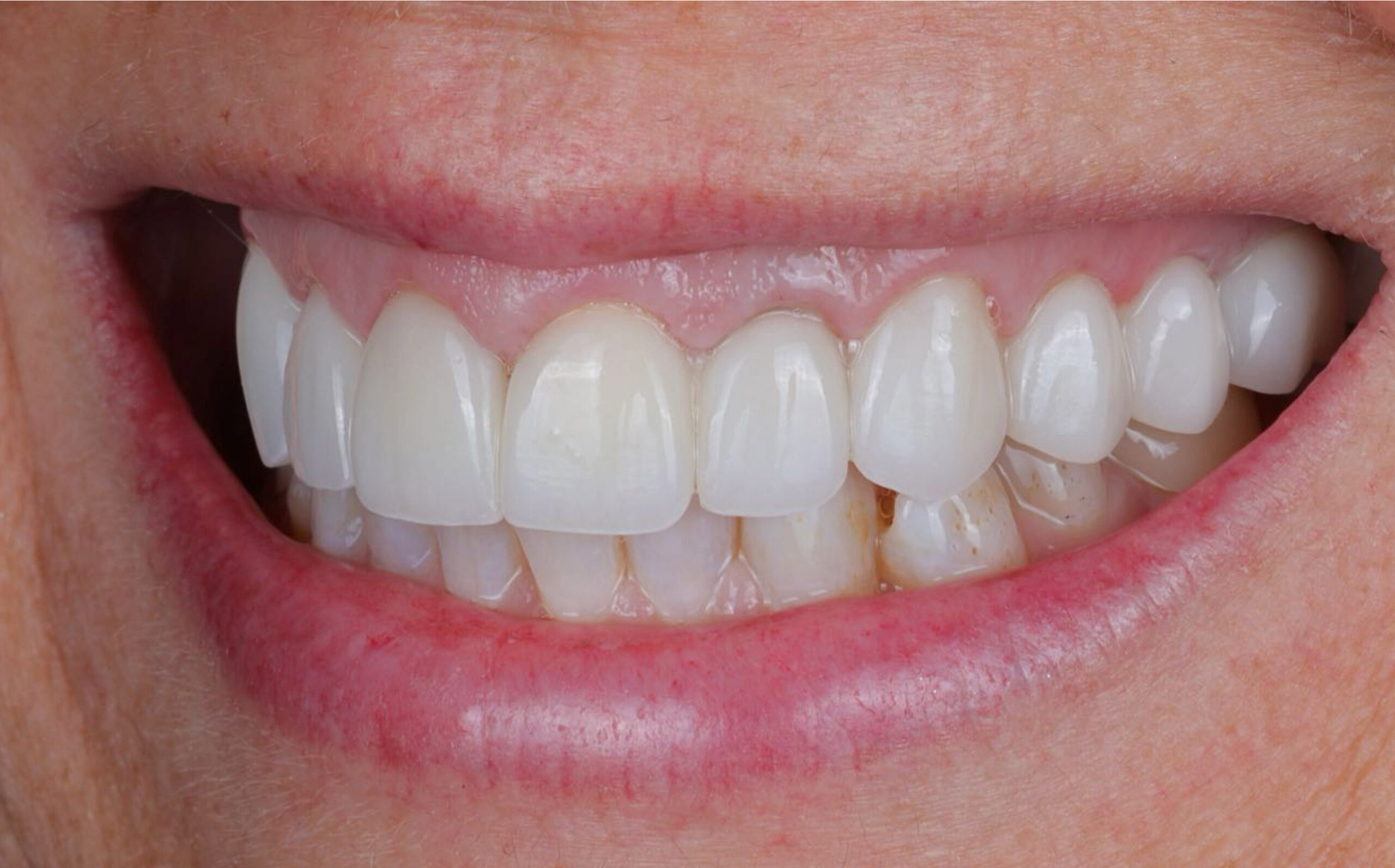 Family Dentistry of Forest Hill | Smile Gallery