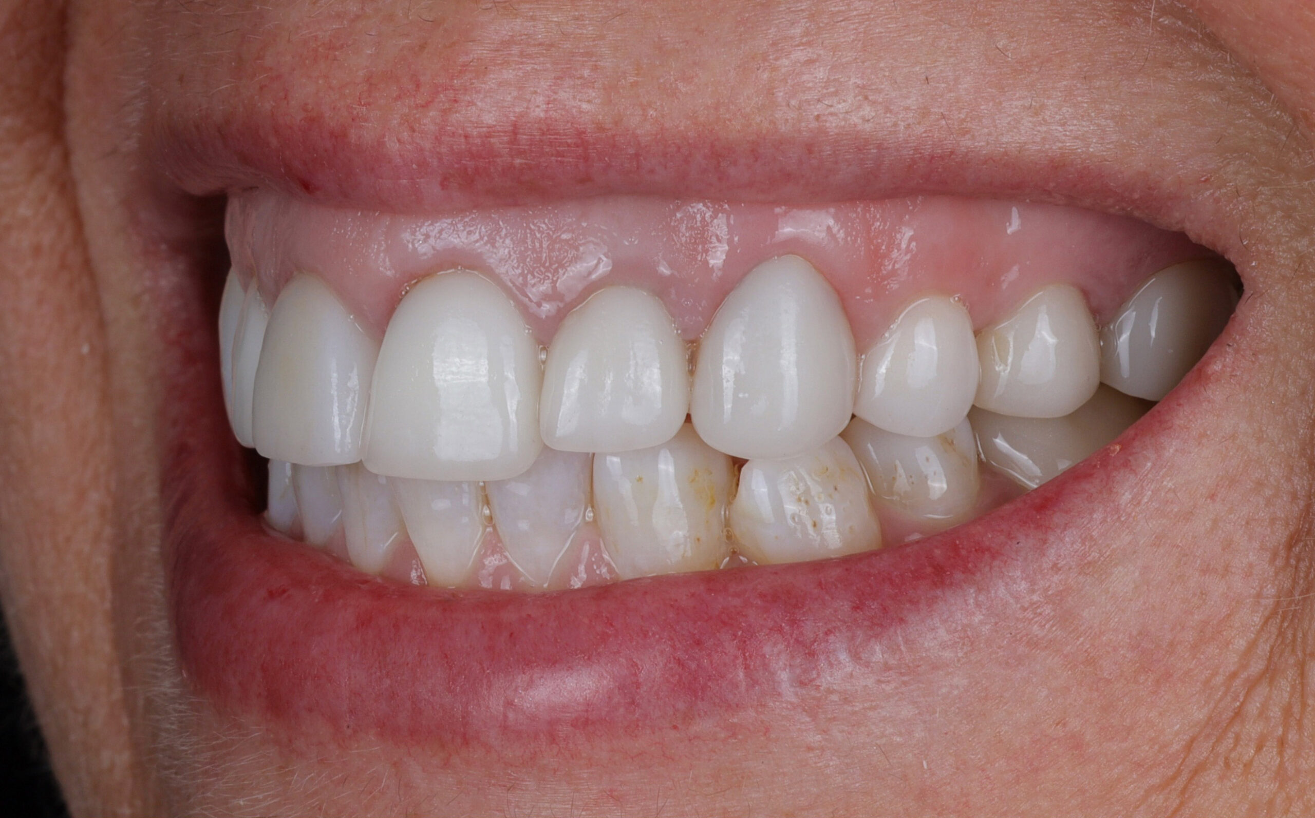 Family Dentistry of Forest Hill | Smile Gallery
