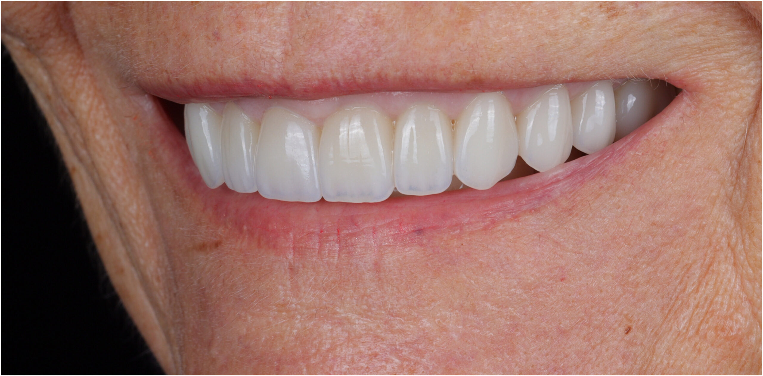 Family Dentistry of Forest Hill | Smile Gallery