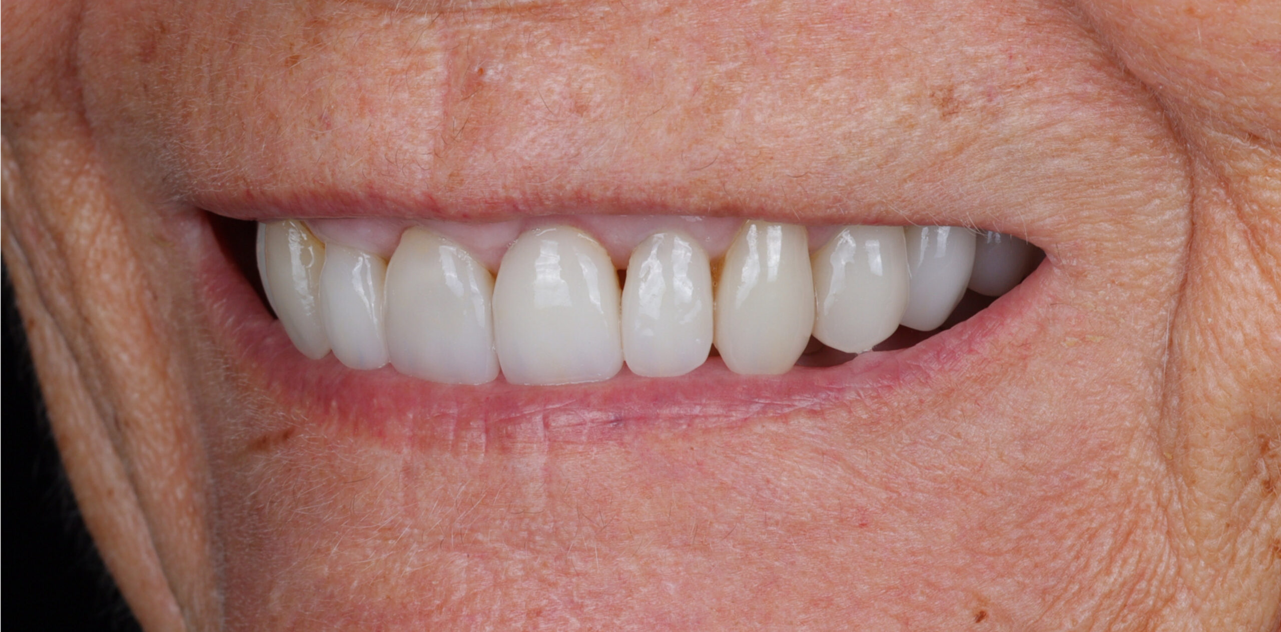 Family Dentistry of Forest Hill | Smile Gallery
