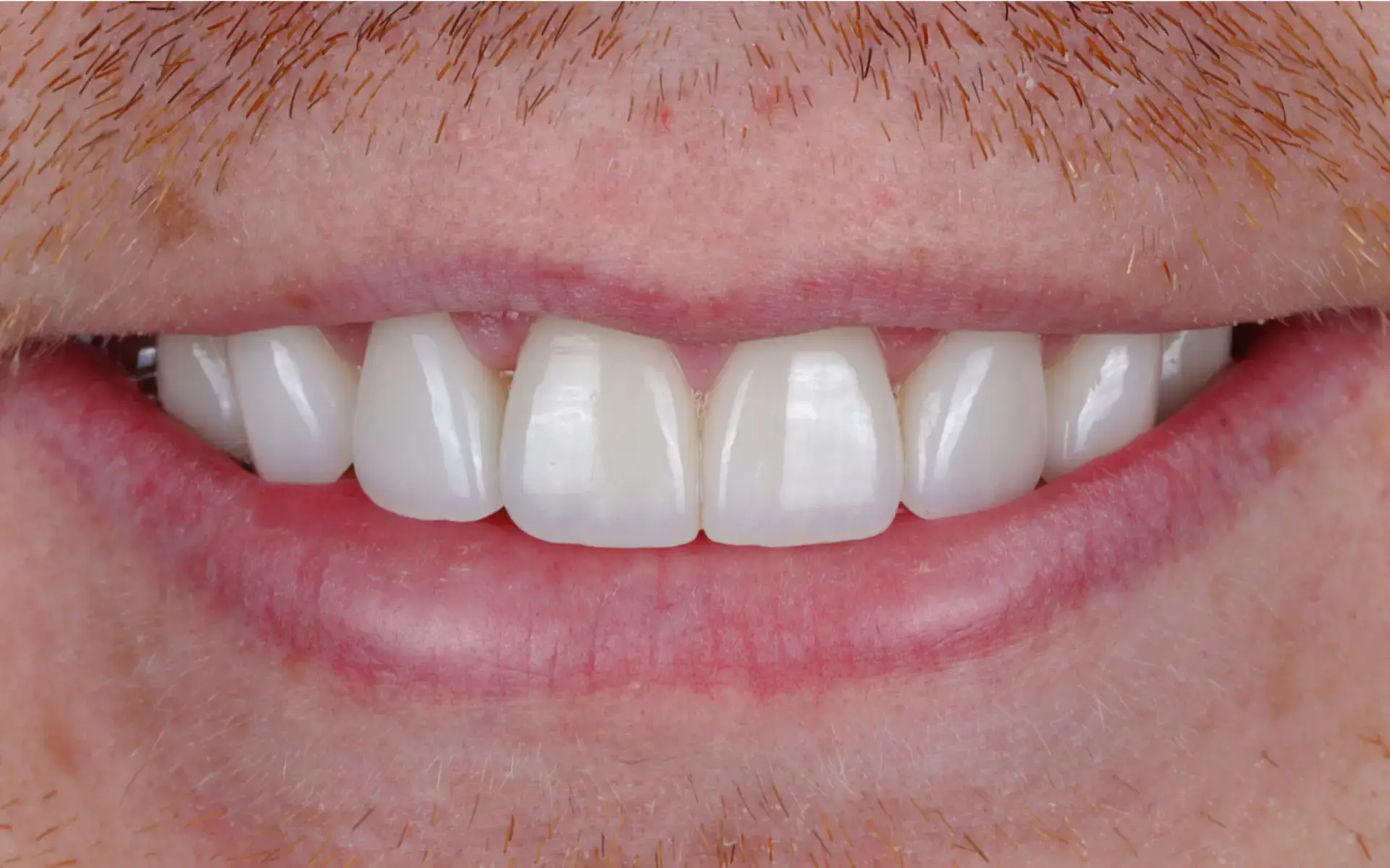 Family Dentistry of Forest Hill | Smile Gallery