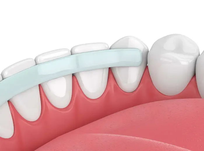Family Dentistry of Forest Hill | Dental Bonding