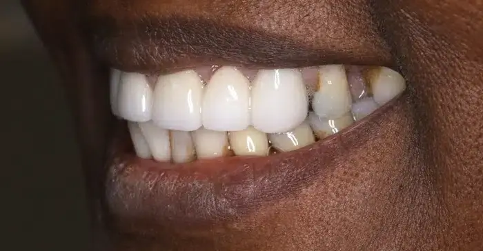 Family Dentistry of Forest Hill | Smile Gallery