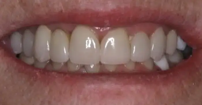 Family Dentistry of Forest Hill | Smile Gallery