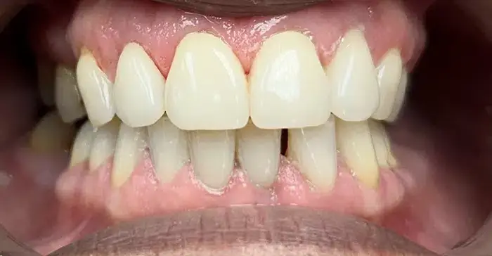 Family Dentistry of Forest Hill before and after result