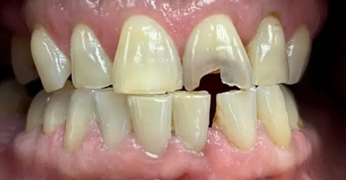 Family Dentistry of Forest Hill before and after result