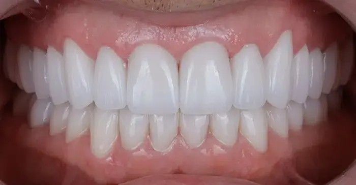 Family Dentistry of Forest Hill before and after result