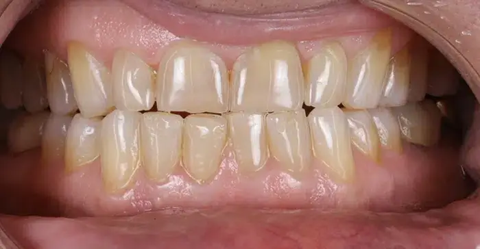 Family Dentistry of Forest Hill before and after result