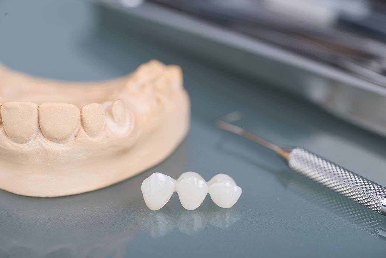 Dental Bridges in West Palm Beach: A Reliable Way to Replace Missing Teeth